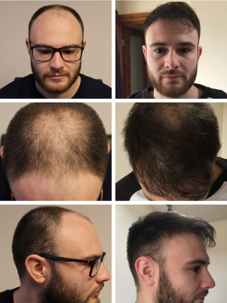 Hair transplant results - Before and after images: 1500 / 2000 / 2500 Grafts