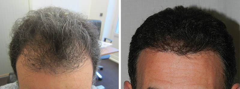 Hair transplant results: