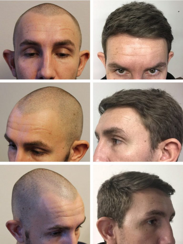 Hair transplant before after - from bald to full head of hair