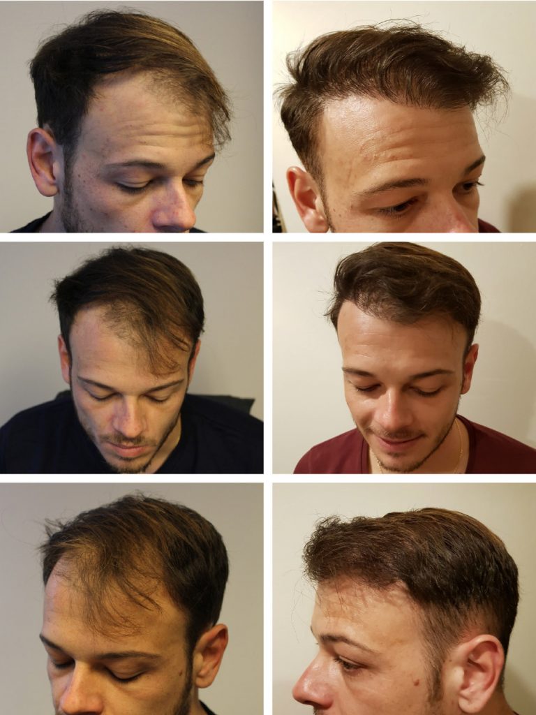 Hair transplants results - hair thickening