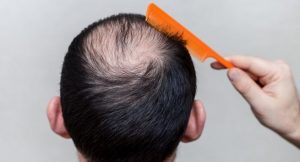 Alternaive hair growth treatments