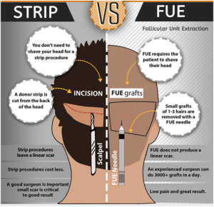FUT vs FUE hair transplant
