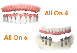 All on 4 dental implants / All on 6 dental implants